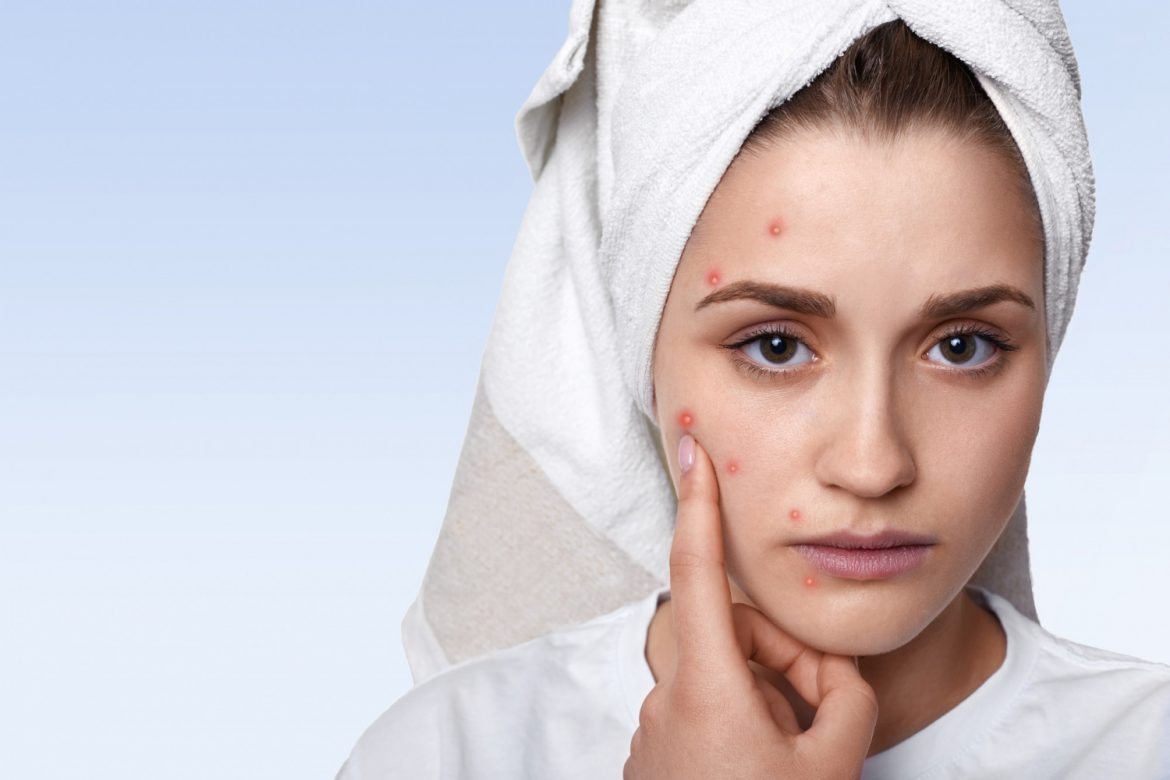 How to Treat Acne and Pimples by Ayurveda